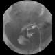 Tumour and fistula of the urinary bladder, fistula of small bowel, fistulography: RF - Fluoroscopy